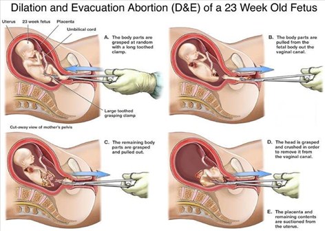 abortus provocatus