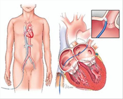 ablation for atrieflimmer